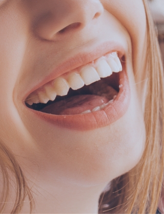 Illustration of a dental crown being placed on a dental implant in the lower jaw