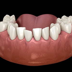 Illustration of crooked teeth