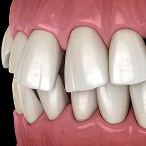 Illustration of gapped teeth