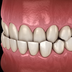 Illustration of an underbite