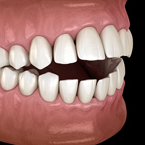 Illustration of an open bite